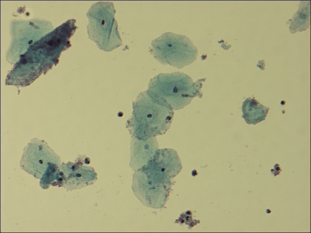 Bacterial Vaginosis : A Complete Overview