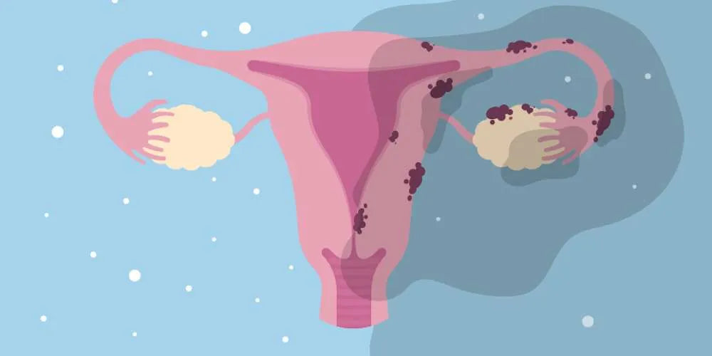 Can I use HRT if I have a history of endometriosis?