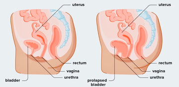 Leaky Bladder and Bladder Prolapse – NeuEve